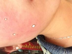 点痣有哪些危害