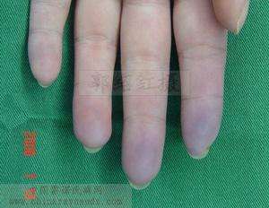 出现紫绀心脏病病情已经较重