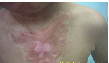 治疗开水烫伤疤痕的三步骤