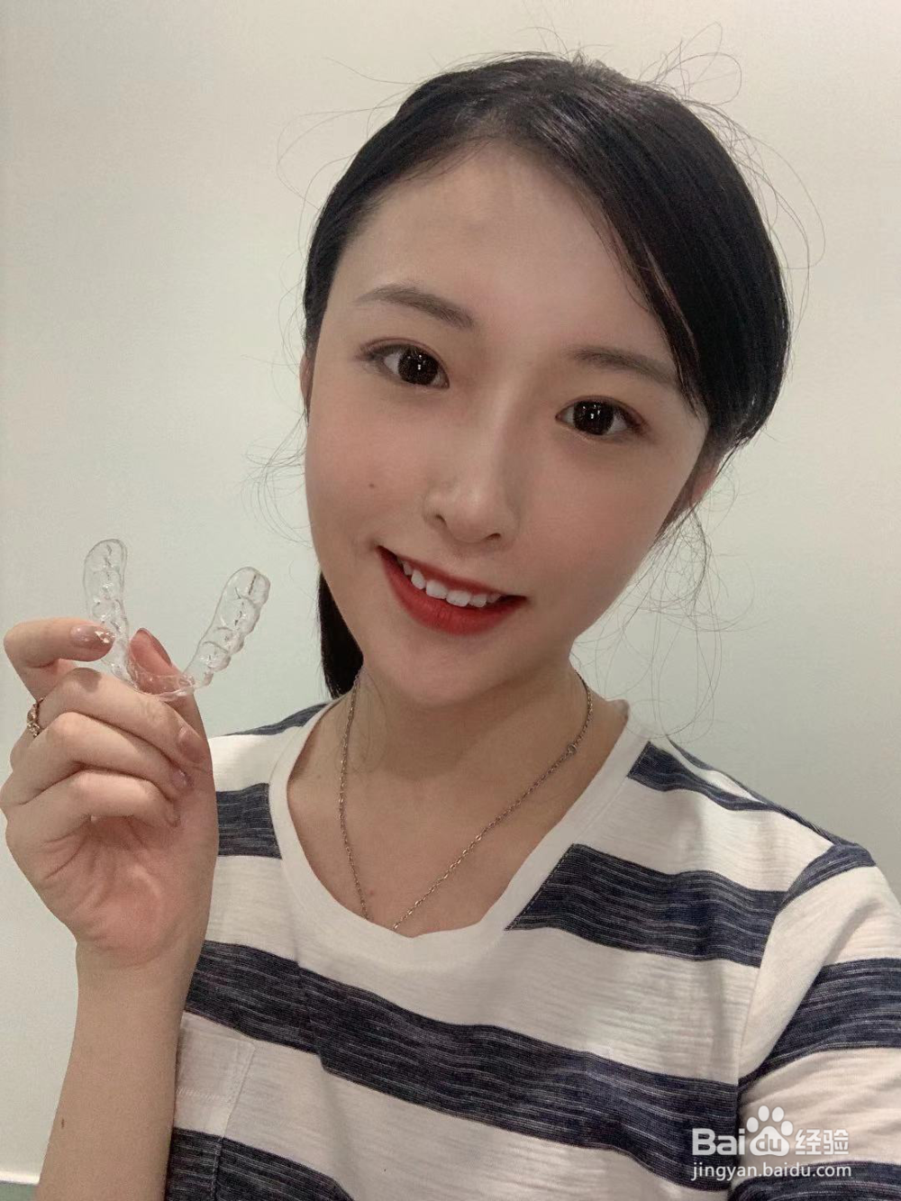 隐形牙套的经历分享，内附详细流程