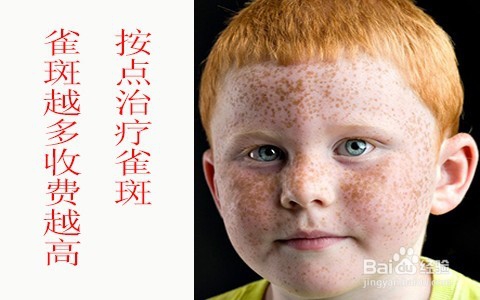 激光祛雀斑价格费用/激光祛斑单次多少钱