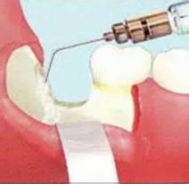 拔智齿过程是怎么样的？