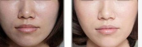怎样收 缩脸部毛孔