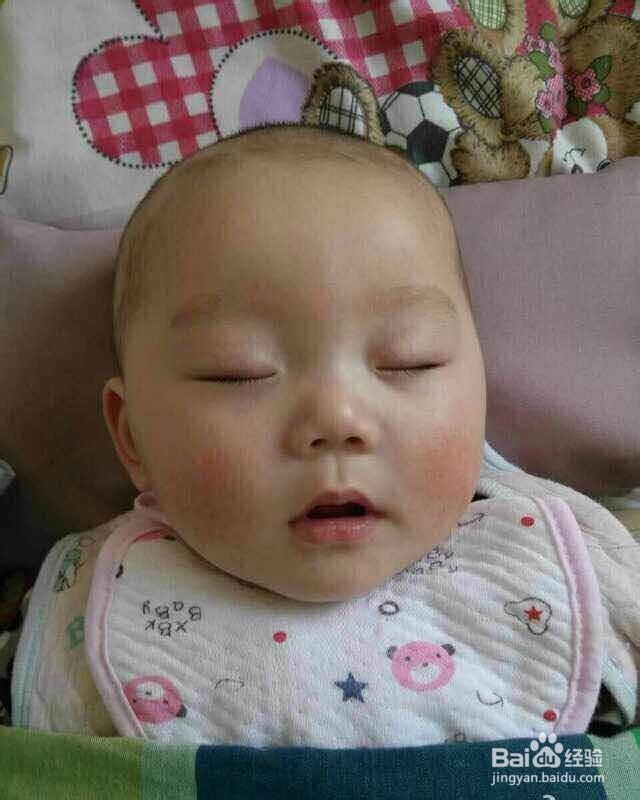 怎样快速修复过敏