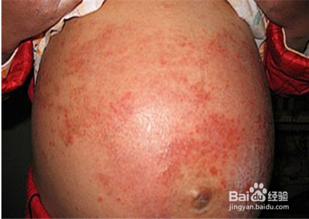 孕妇手脚长湿疹怎么办