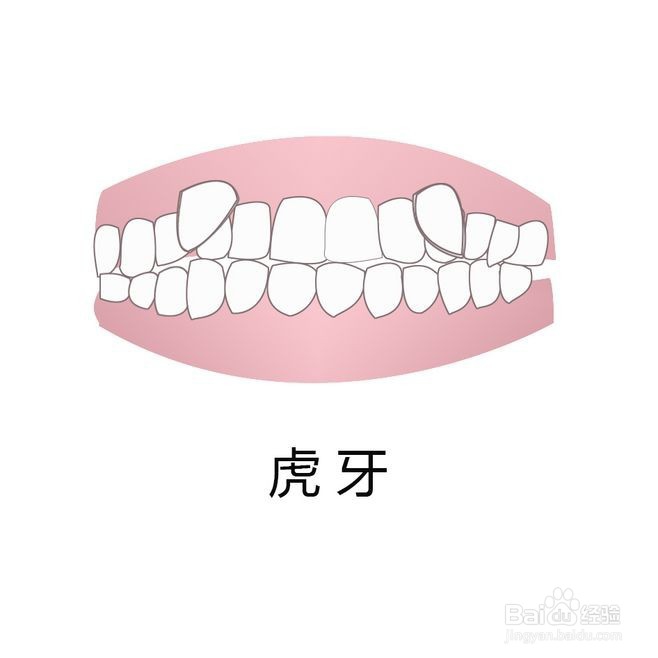 牙齿矫正类型图片