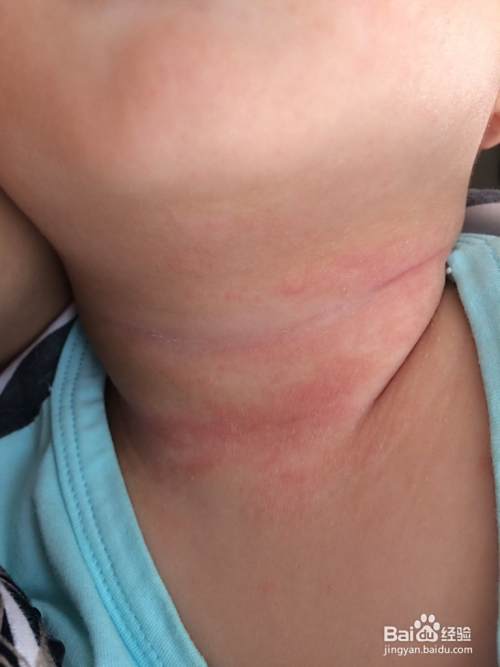 脖子起湿疹怎么办 百度经验
