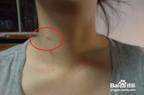 脖子两边长痘痘该怎么办