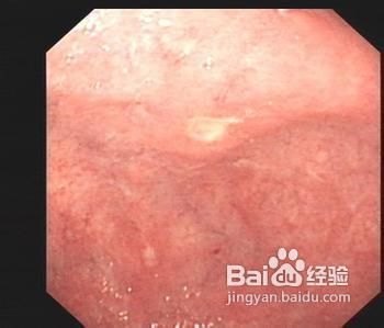 哪些因素会引发萎缩性胃炎