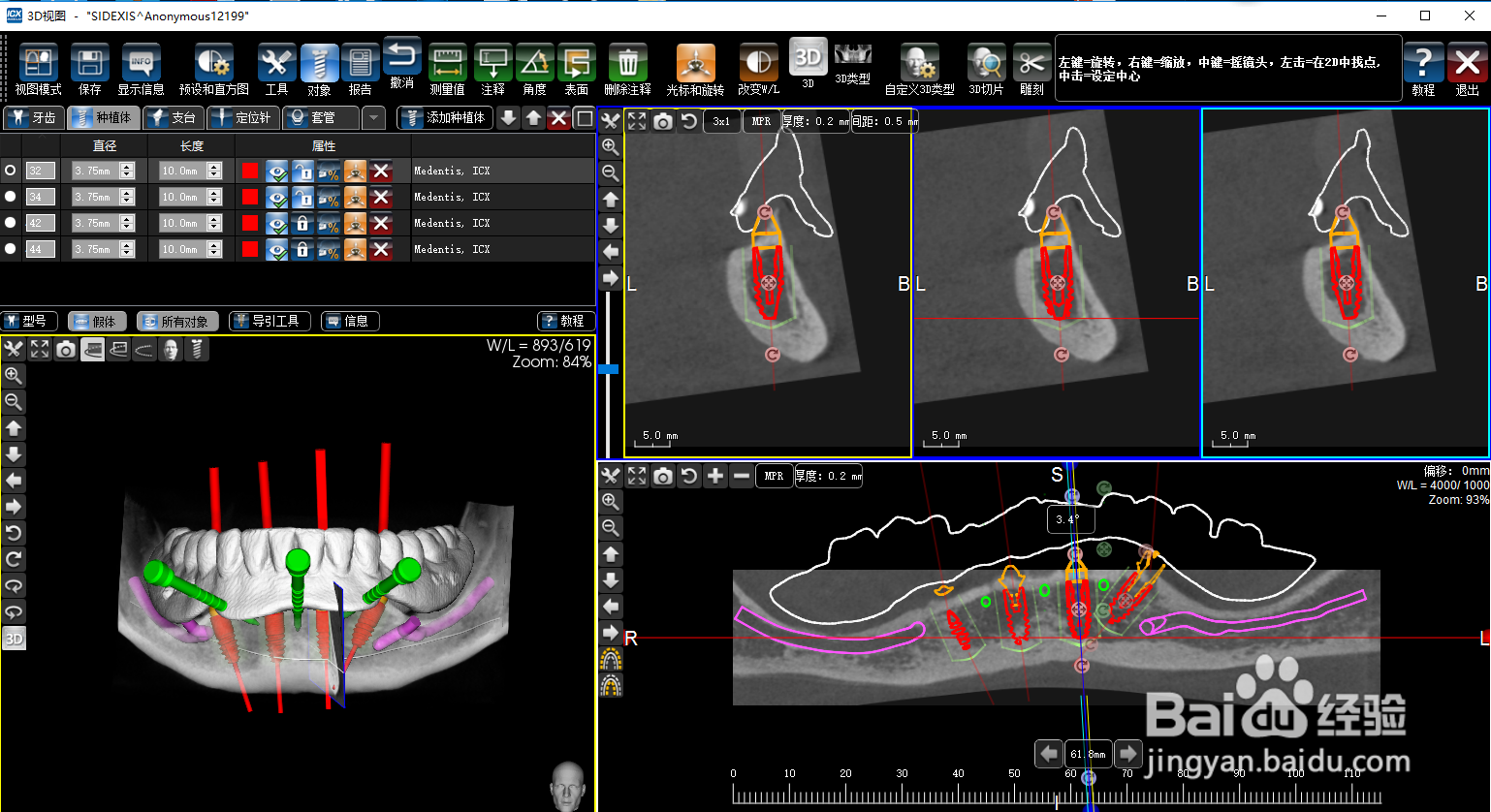 牙齿缺失|数字化种植牙与传统种植牙的区别