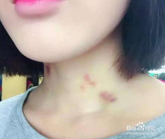 脖子吻痕怎么消除