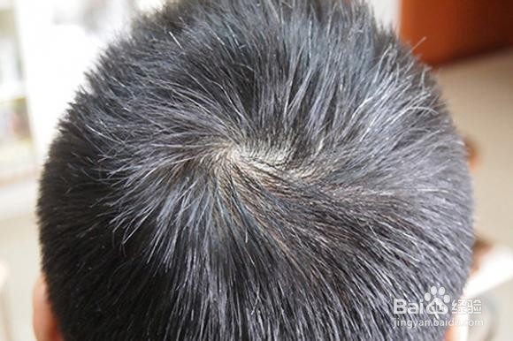 长白头发的原因及调理