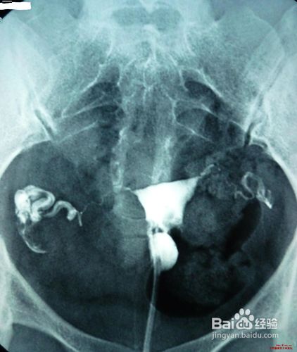 习惯性流产要如何检查