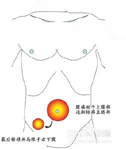带你认识常见病：[4]急性阑尾炎