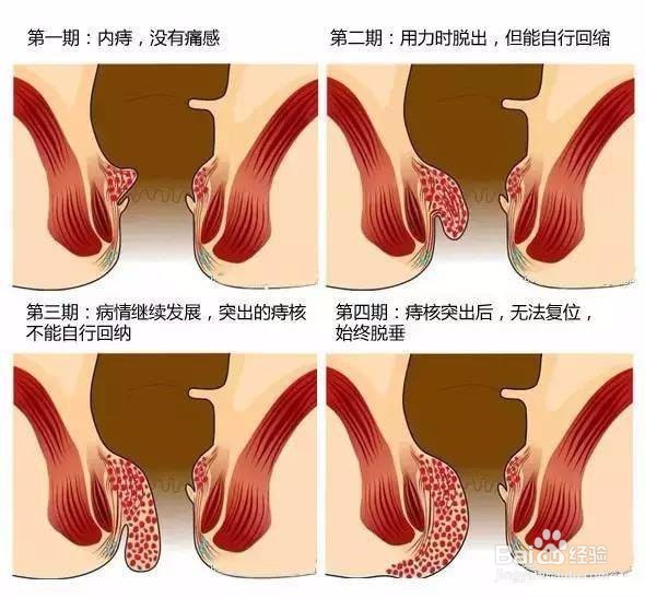 痔疮是否需要手术治疗