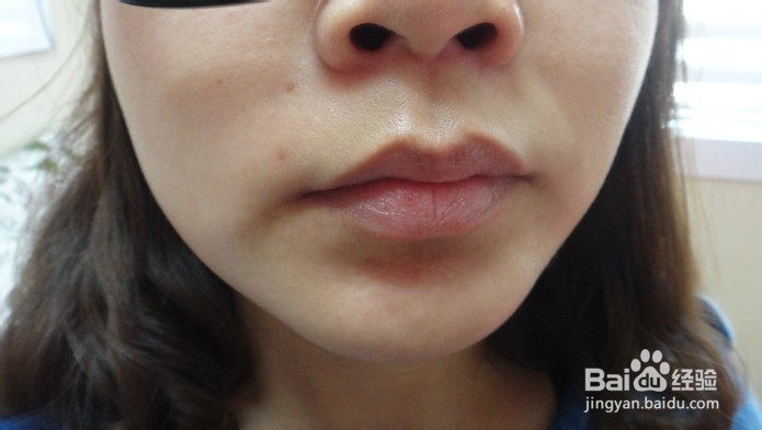唇毛脱毛全过程