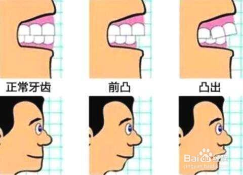 昌平牙齿矫正分哪几种类型