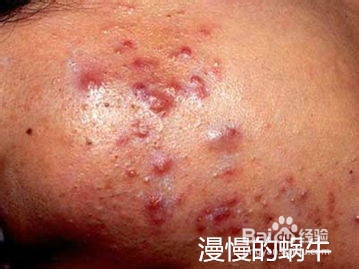 各种痘痘类型各种对应处理