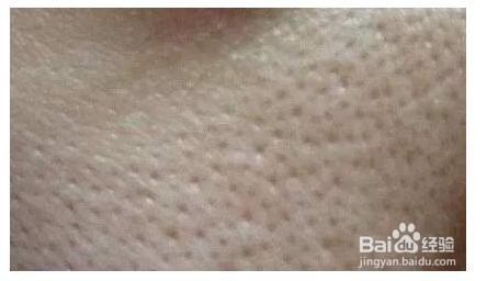 油性皮肤毛孔粗大怎么办