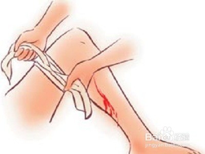 外出血的止血方法
