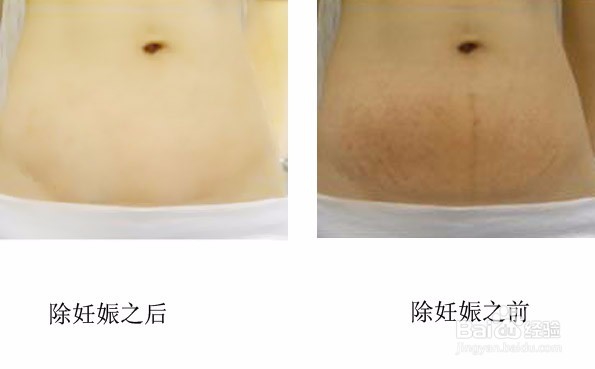 孕妈怎样避免或减轻妊娠纹