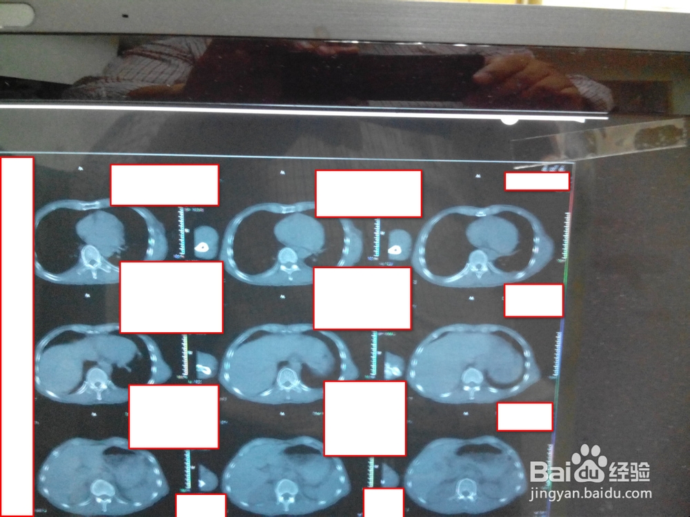 拍摄医院CT，X光片技巧