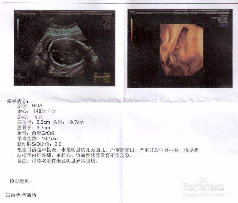 孕中期如何进行安全合理的产检