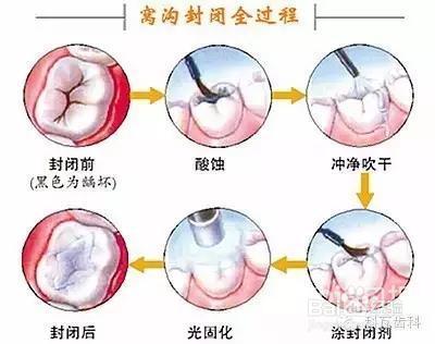 孩子六龄齿窝沟封闭有必要吗?九成父母都不知道