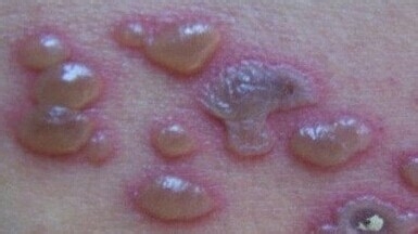 水痘的症状和治疗