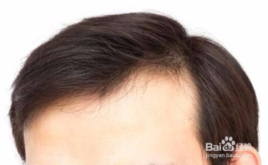 发际线后退严重怎么办?送恢复经验