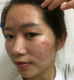 怎么祛痘痘最有效的方法