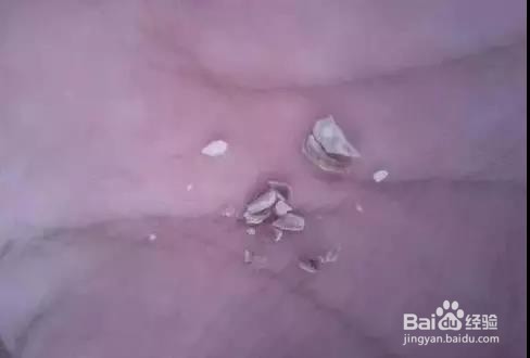 什么是深度洗牙