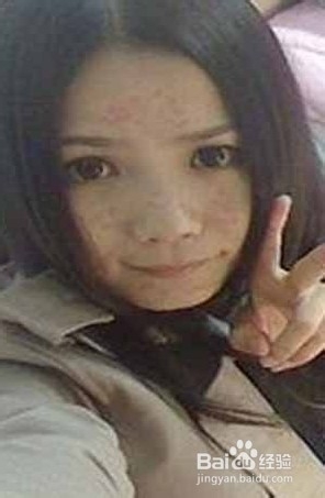 教你如何快速祛痘的有效方法