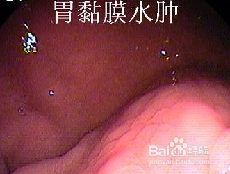 浅表性胃炎的影响有哪些