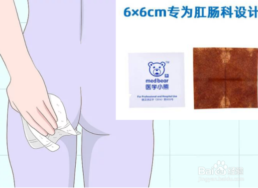 得了痔疮怎么办必须要手术治疗吗