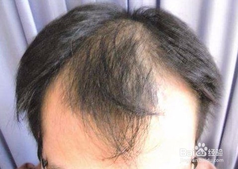 健身导致脱发怎么办