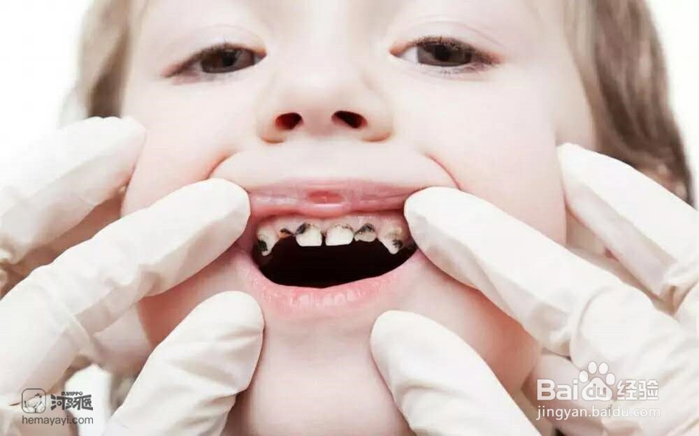 儿童蛀牙奶瓶龋怎么办?