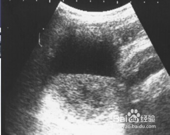 胆道系统几种常见疾病的影像图片。