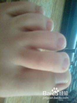 正确认识脚气 方可正确治疗