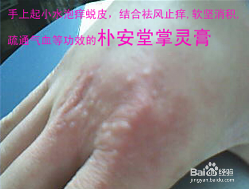 汗疱疹怎么办【精华版】