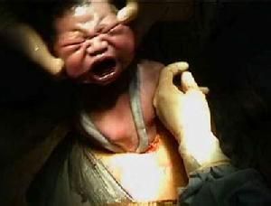 孕妇遇到怎样的情况需要剖腹产