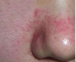 春暖花开如何有效预防过敏性鼻炎？