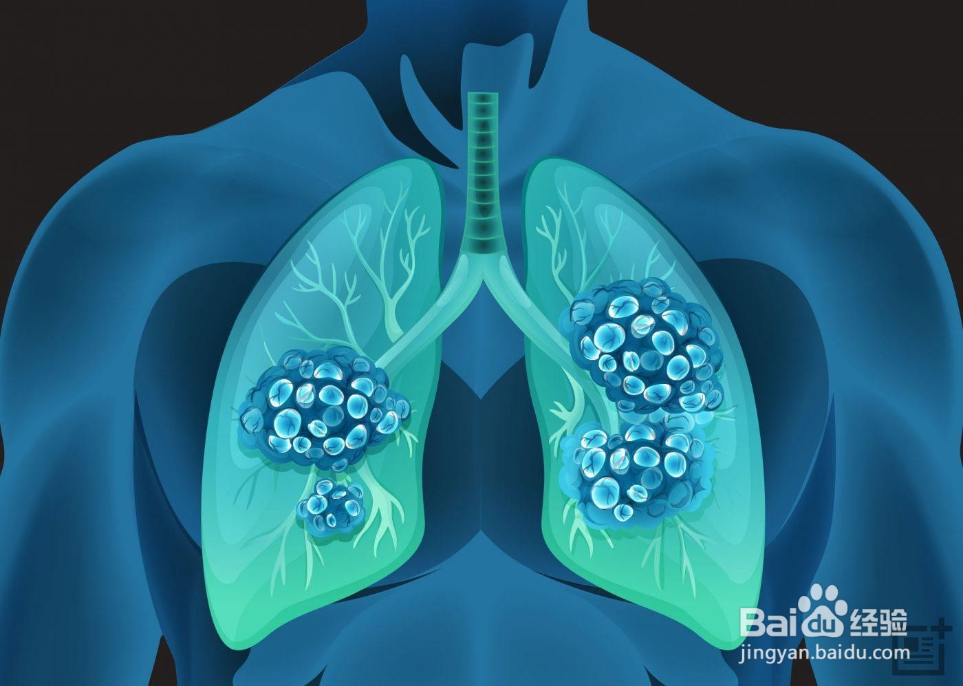 如何才能发现间质性肺炎早期症状