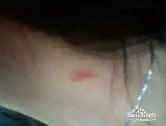 脖子吻痕怎么消除