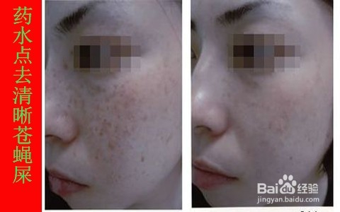脸上蝇子屎吃什么去除/药水可以点掉苍蝇屎吗