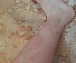 湿疹太痒怎么办，做到这几点就可以