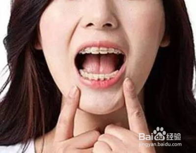 牙齿矫正的骨钉是什么？