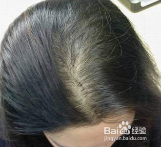 严重脱发怎么办?