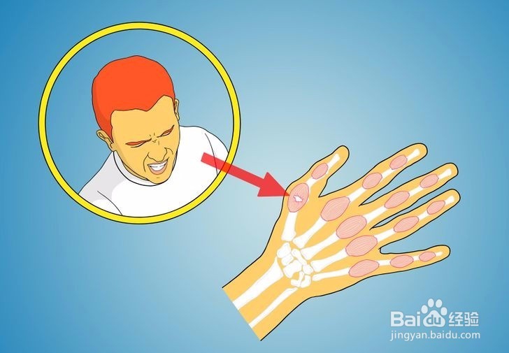 如何诊断拇指是否骨折?