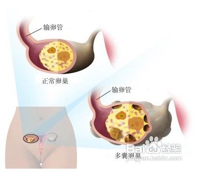 得了多囊卵巢怎么办